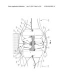 ORTHOTIC BRACE TIGHTENING DEVICE diagram and image