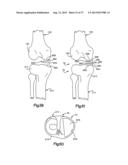 TIBIAL GUIDE FOR KNEE SURGERY diagram and image