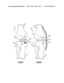 TIBIAL GUIDE FOR KNEE SURGERY diagram and image