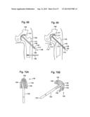 TIBIAL GUIDE FOR KNEE SURGERY diagram and image