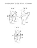 TIBIAL GUIDE FOR KNEE SURGERY diagram and image