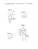 TIBIAL GUIDE FOR KNEE SURGERY diagram and image