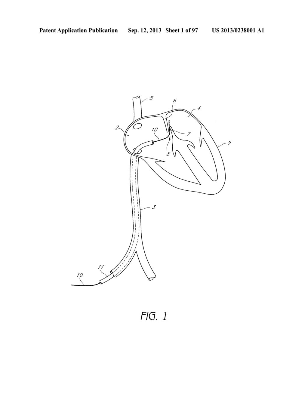 Suturing Devices and Methods for Closing a Patent Foramen Ovale - diagram, schematic, and image 02