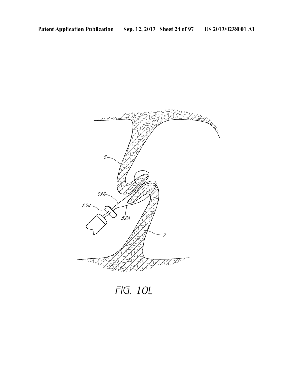 Suturing Devices and Methods for Closing a Patent Foramen Ovale - diagram, schematic, and image 25