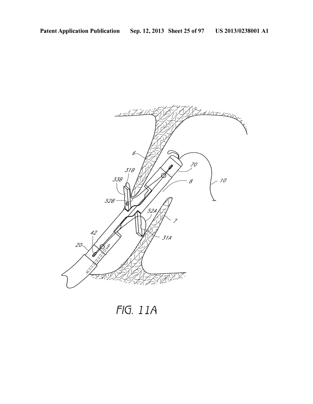 Suturing Devices and Methods for Closing a Patent Foramen Ovale - diagram, schematic, and image 26