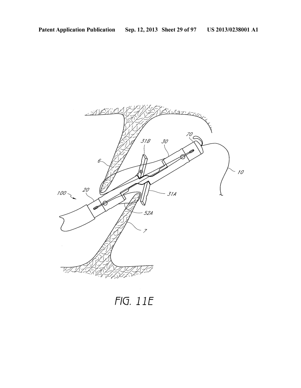 Suturing Devices and Methods for Closing a Patent Foramen Ovale - diagram, schematic, and image 30