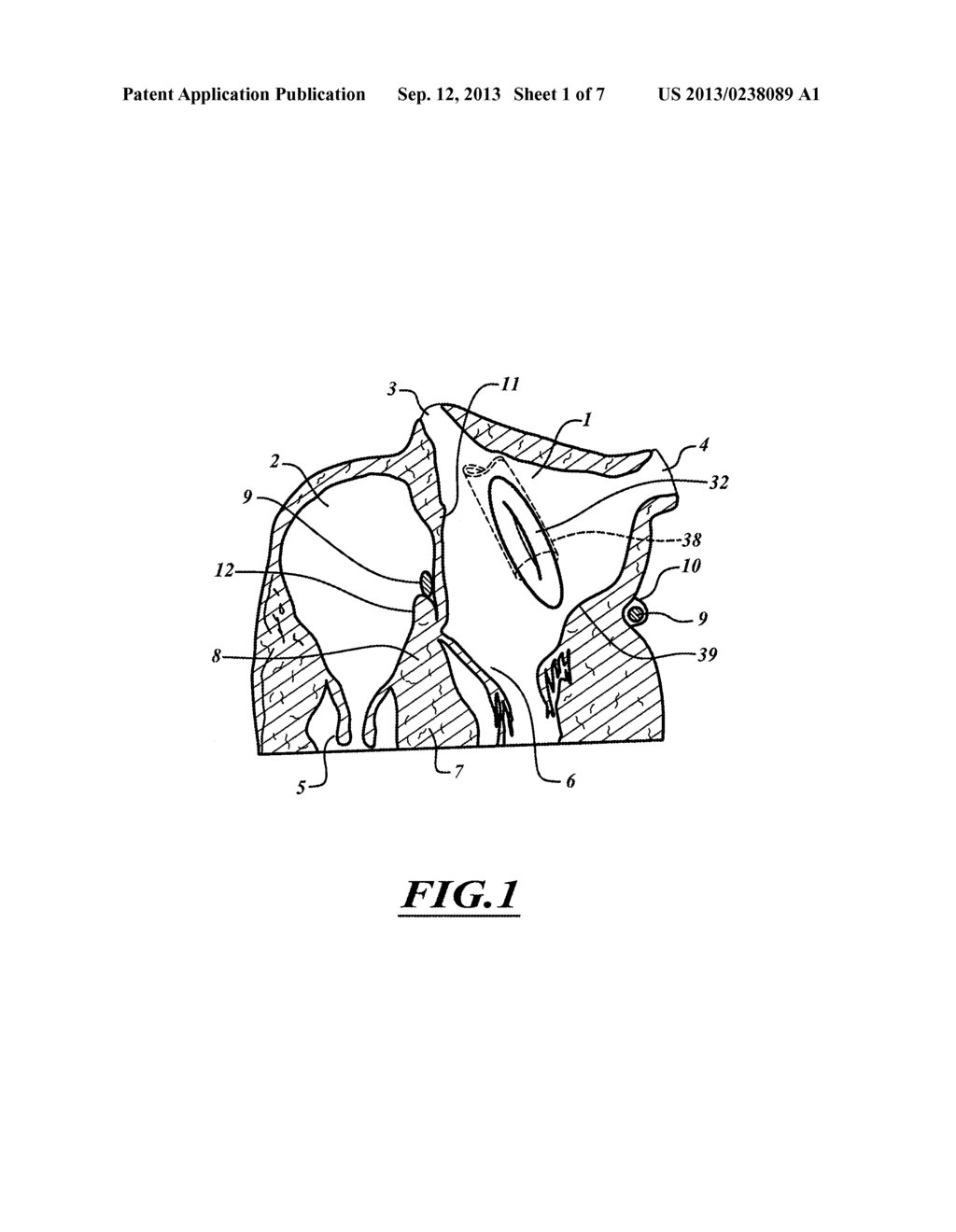 METHOD FOR ANCHORING A MITRAL VALVE - diagram, schematic, and image 02