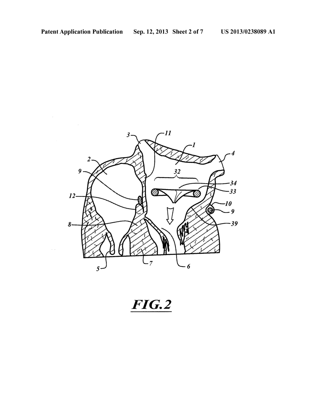 METHOD FOR ANCHORING A MITRAL VALVE - diagram, schematic, and image 03