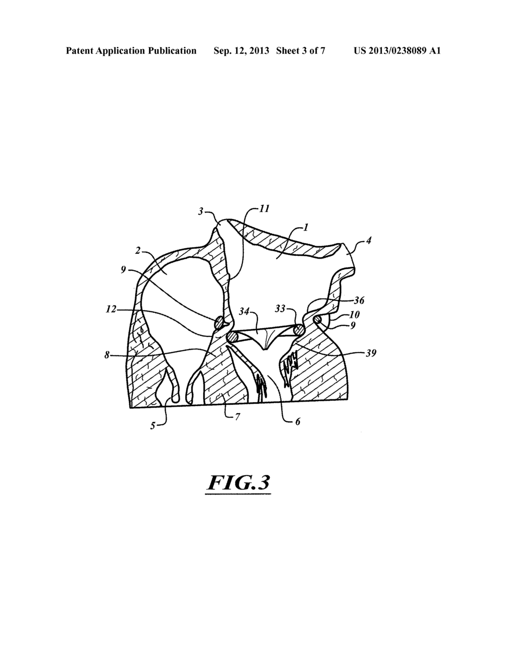 METHOD FOR ANCHORING A MITRAL VALVE - diagram, schematic, and image 04