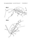 Eraser Bracelet diagram and image