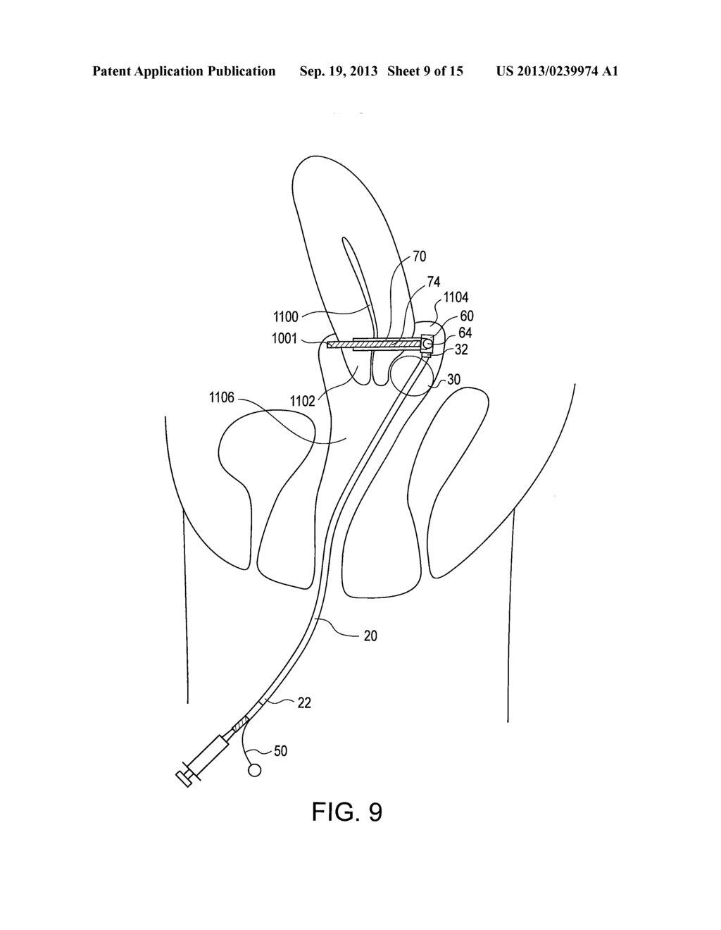 CERVICAL CERCLAGE ASSISTANCE DEVICE - diagram, schematic, and image 10