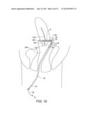 CERVICAL CERCLAGE ASSISTANCE DEVICE diagram and image