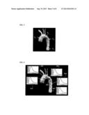 Method and System for Hemodynamic Assessment of Aortic Coarctation from     Medical Image Data diagram and image