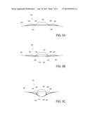 DEVICE FEATURES AND DESIGN ELEMENTS FOR LONG-TERM ADHESION diagram and image