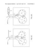 MINIMALLY INVASIVE DETERMINATION OF COLLATERAL VENTILATION IN LUNGS diagram and image