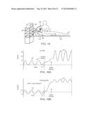 MINIMALLY INVASIVE DETERMINATION OF COLLATERAL VENTILATION IN LUNGS diagram and image