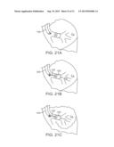 MINIMALLY INVASIVE DETERMINATION OF COLLATERAL VENTILATION IN LUNGS diagram and image