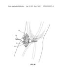 SUBCUTANEOUS VASCULAR ACCESS PORTS diagram and image