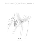 SUBCUTANEOUS VASCULAR ACCESS PORTS diagram and image