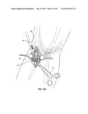 SUBCUTANEOUS VASCULAR ACCESS PORTS diagram and image