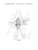 SUBCUTANEOUS VASCULAR ACCESS PORTS diagram and image