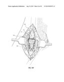 SUBCUTANEOUS VASCULAR ACCESS PORTS diagram and image