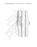 SUBCUTANEOUS VASCULAR ACCESS PORTS diagram and image