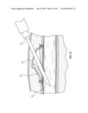 SUBCUTANEOUS VASCULAR ACCESS PORTS diagram and image