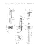 IMPLANT FOR STABILIZING BONES OR VERTEBRAE diagram and image