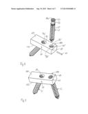 IMPLANT FOR STABILIZING BONES OR VERTEBRAE diagram and image