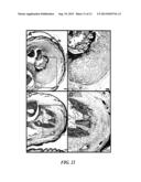 SLEEVE FOR STIMULATION OF TISSUE REGENERATION diagram and image