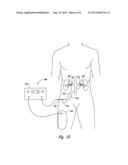 Methods and Apparatus for Multi-Vessel Renal Neuromodulation diagram and image