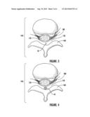 SELF-ANCHORED STIMULATOR LEAD AND METHOD OF INSERTION diagram and image