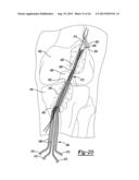 Method And Apparatus For Tibial Fixation Of An ACL Graft diagram and image