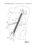 Method And Apparatus For Tibial Fixation Of An ACL Graft diagram and image