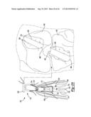 Method And Apparatus For Tibial Fixation Of An ACL Graft diagram and image