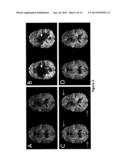 MRI DATA ACQUISITION, RECONSTRUCTION AND CORRECTION METHODS FOR DIFFUSION     WEIGHTED IMAGING (DWI) AND DIFFUSION TENSOR IMAGING (DTI) AND RELATED     SYSTEMS diagram and image