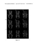 MRI DATA ACQUISITION, RECONSTRUCTION AND CORRECTION METHODS FOR DIFFUSION     WEIGHTED IMAGING (DWI) AND DIFFUSION TENSOR IMAGING (DTI) AND RELATED     SYSTEMS diagram and image