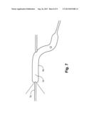 GUIDE FOR PLACEMENT OF CATHETER INTO BRAIN AND A METHOD OF UTILIZING THE     SAME diagram and image