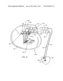 SWITCHED DIVERTER CIRCUITS FOR MINIMIZING HEATING OF AN IMPLANTED LEAD     AND/OR PROVIDING EMI PROTECTION IN A HIGH POWER ELECTROMAGNETIC FIELD     ENVIRONMENT diagram and image