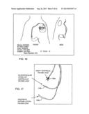 SWITCHED DIVERTER CIRCUITS FOR MINIMIZING HEATING OF AN IMPLANTED LEAD     AND/OR PROVIDING EMI PROTECTION IN A HIGH POWER ELECTROMAGNETIC FIELD     ENVIRONMENT diagram and image