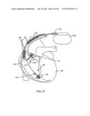 SWITCHED DIVERTER CIRCUITS FOR MINIMIZING HEATING OF AN IMPLANTED LEAD     AND/OR PROVIDING EMI PROTECTION IN A HIGH POWER ELECTROMAGNETIC FIELD     ENVIRONMENT diagram and image