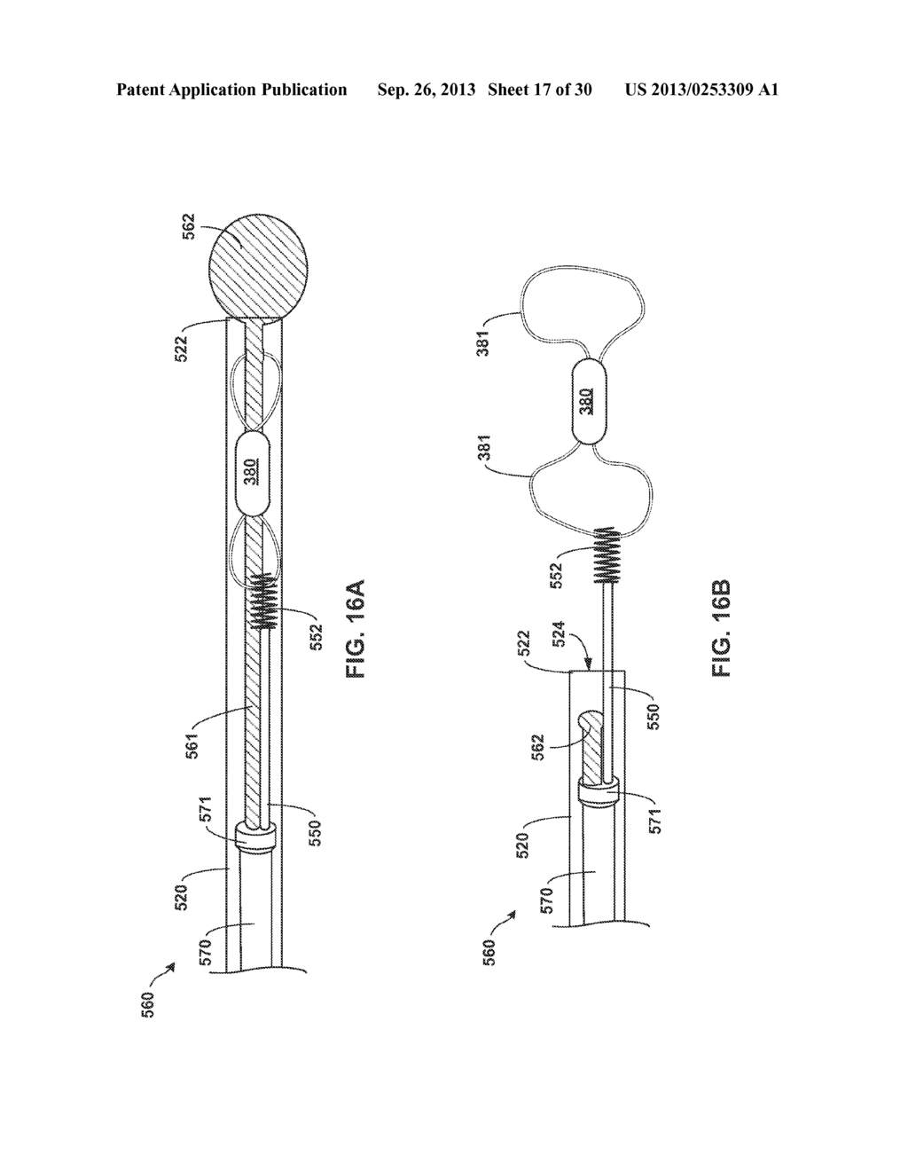 IMPLANTABLE MEDICAL DEVICE DEPLOYMENT WITHIN A VESSEL - diagram, schematic, and image 18