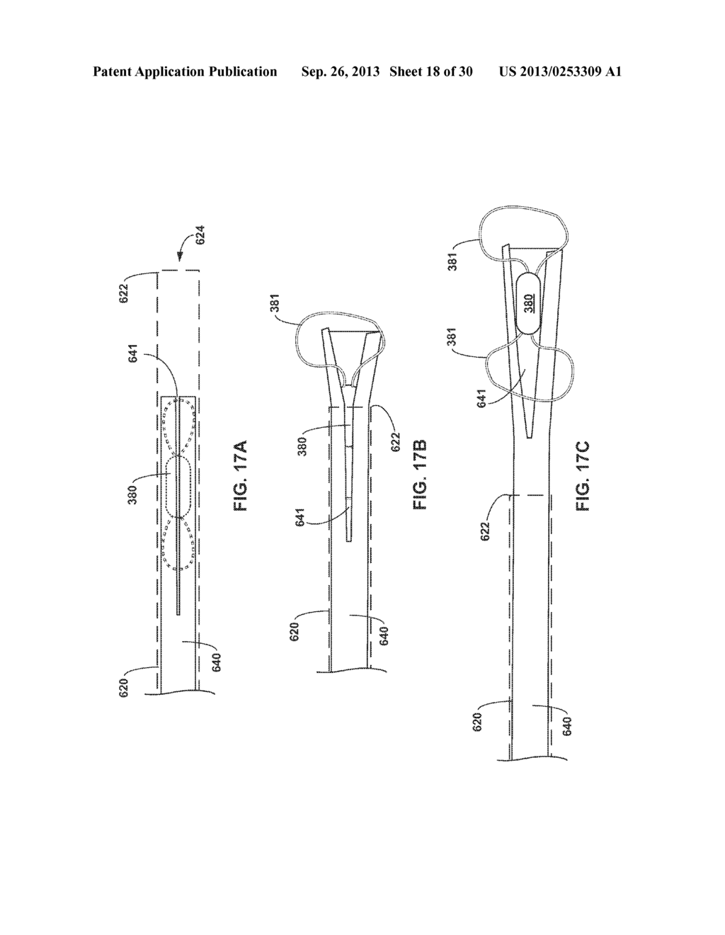 IMPLANTABLE MEDICAL DEVICE DEPLOYMENT WITHIN A VESSEL - diagram, schematic, and image 19