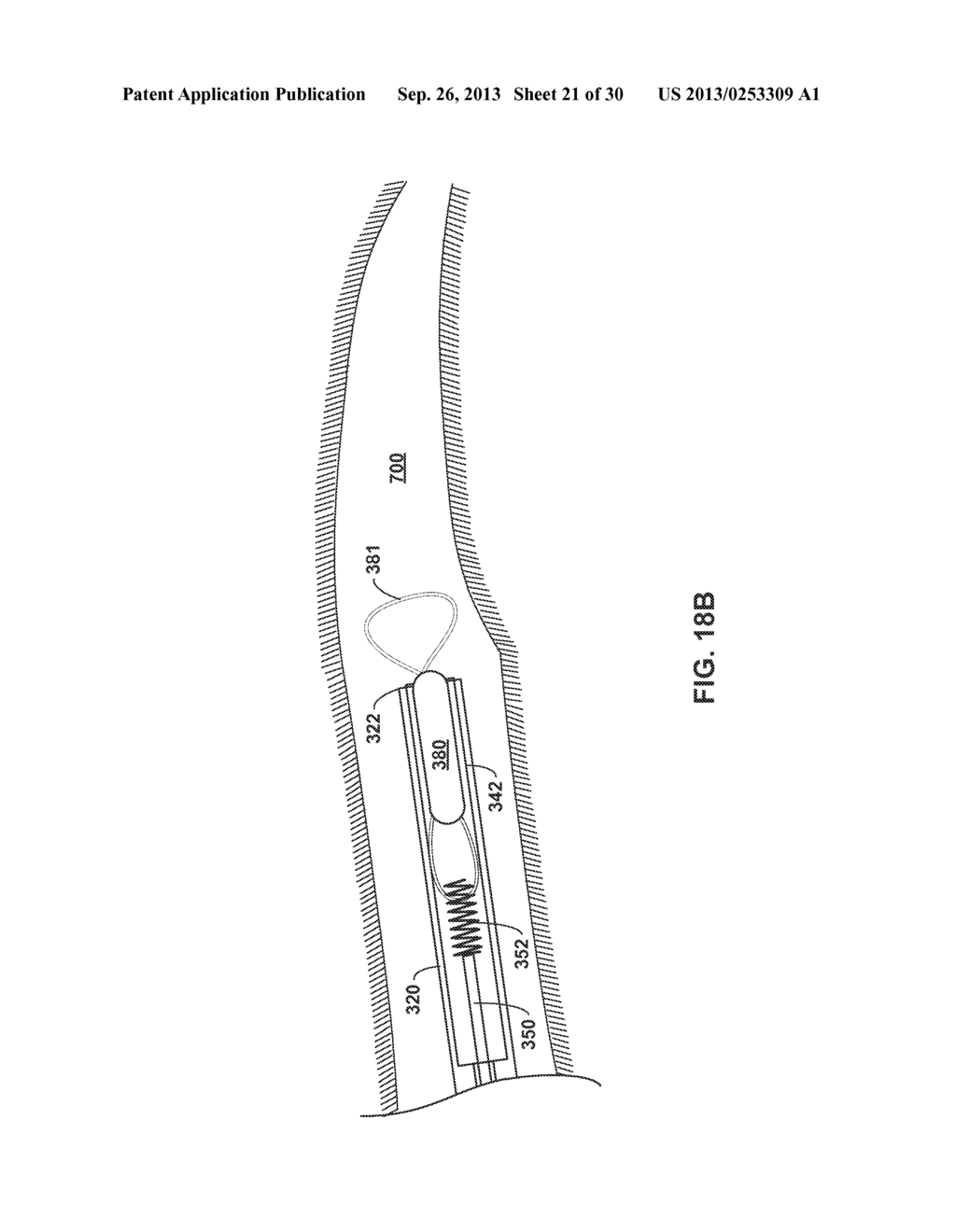 IMPLANTABLE MEDICAL DEVICE DEPLOYMENT WITHIN A VESSEL - diagram, schematic, and image 22