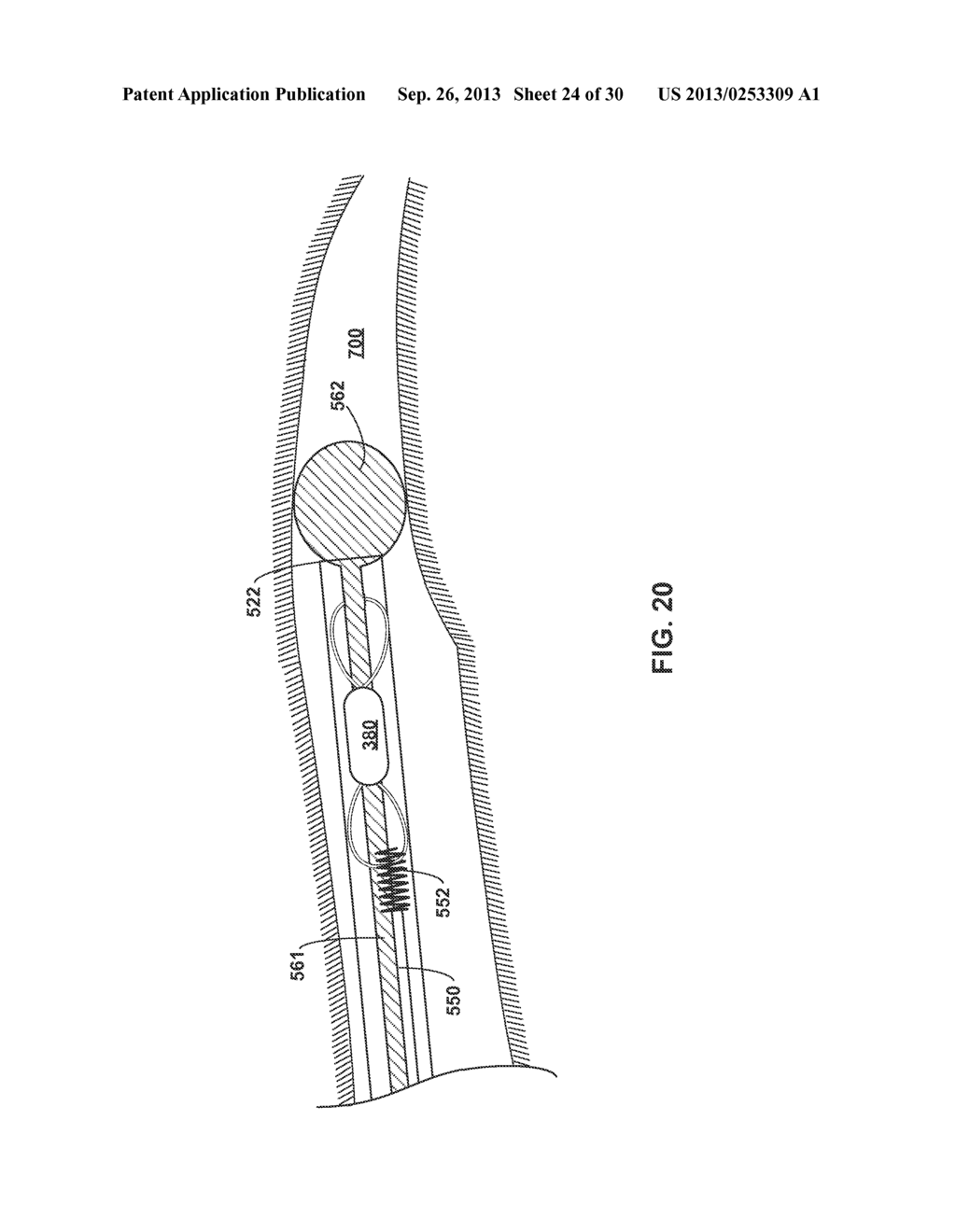 IMPLANTABLE MEDICAL DEVICE DEPLOYMENT WITHIN A VESSEL - diagram, schematic, and image 25