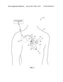 INTRAVASCULAR IMPLANTABLE MEDICAL DEVICE INTRODUCTION diagram and image