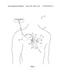 TETHERED IMPLANTABLE MEDICAL DEVICE DEPLOYMENT diagram and image