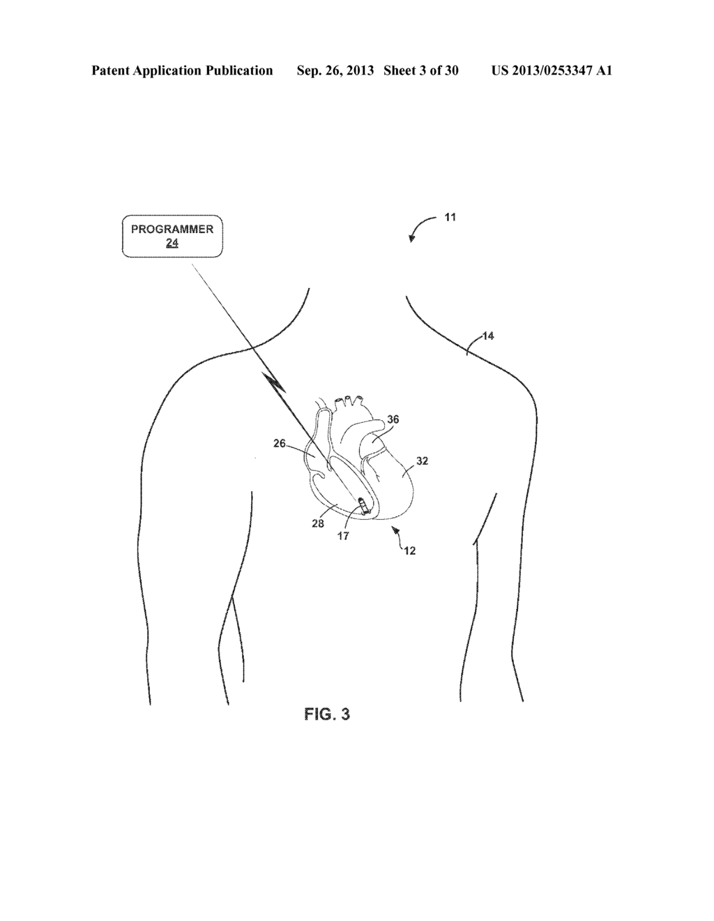 TETHERED IMPLANTABLE MEDICAL DEVICE DEPLOYMENT - diagram, schematic, and image 04