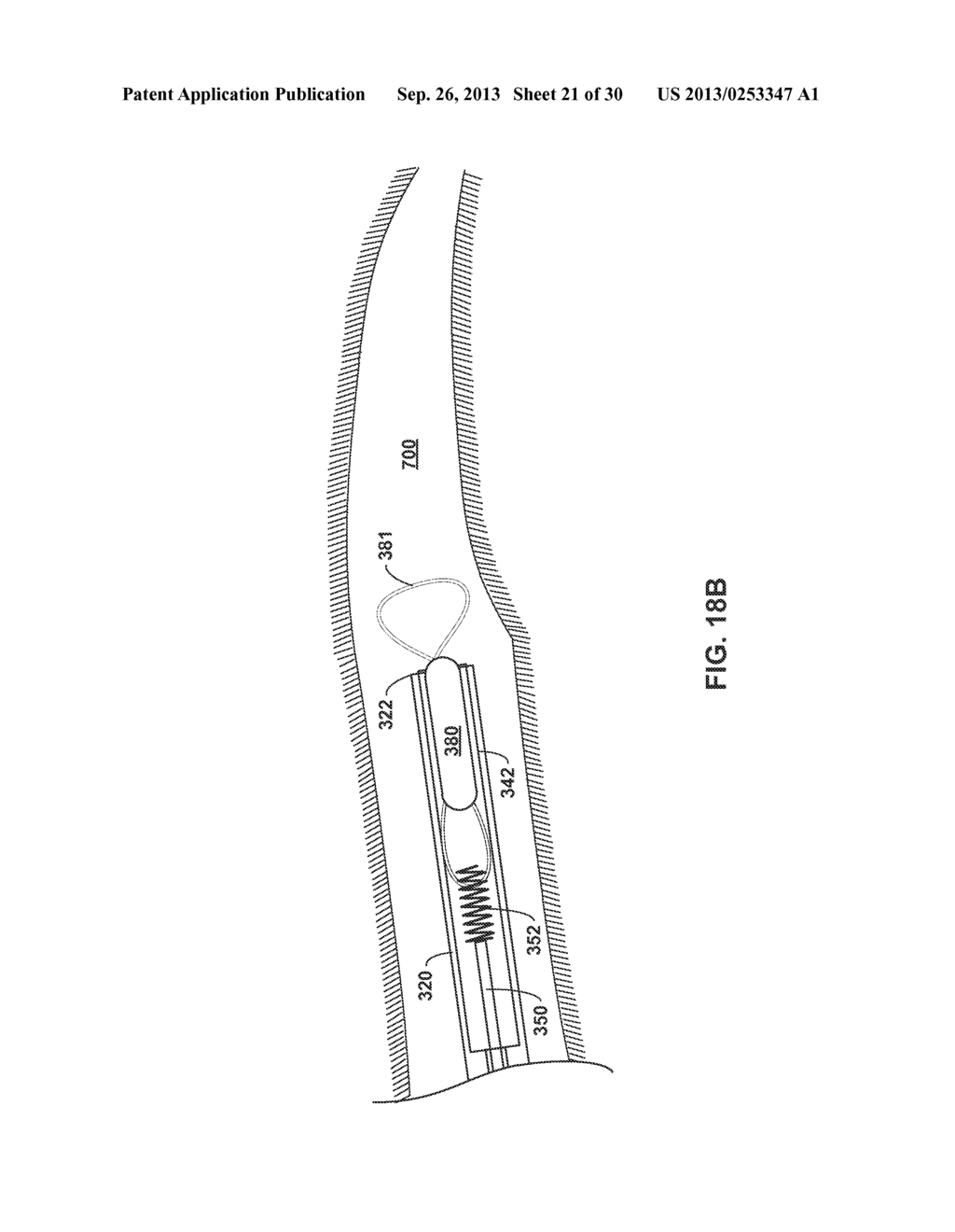 TETHERED IMPLANTABLE MEDICAL DEVICE DEPLOYMENT - diagram, schematic, and image 22